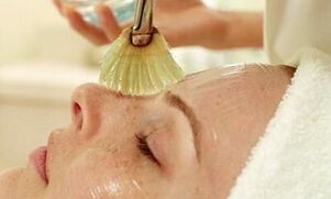 теріні жасартуға арналған мезолифтинг процедурасы